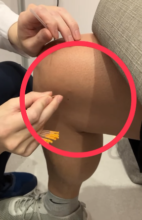 減壓針｜膝蓋治療醫案